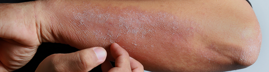 3 de cada 10 chilenos tiene dermatitis atópica ¿Qué es y cómo tratarla?