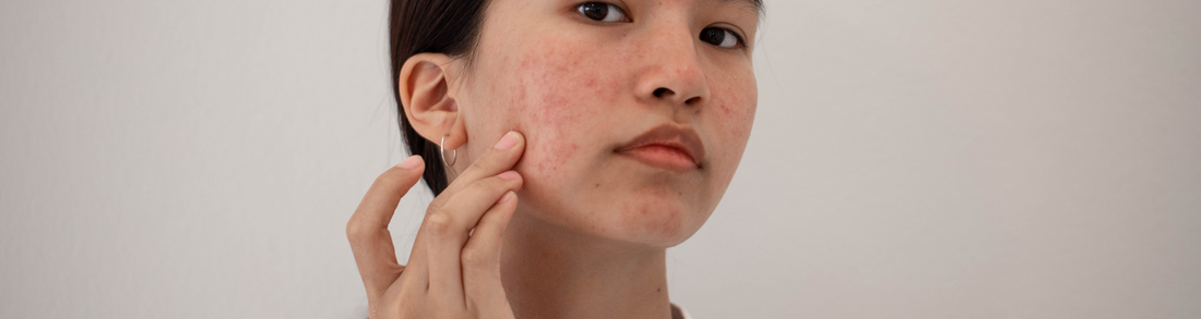 ¿Qué cuidados necesita una piel con Dermatitis Seborreica?