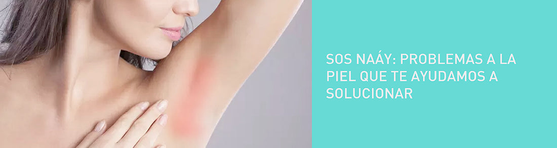 SOS Naáy: Problemas a la piel que te ayudamos a solucionar. 