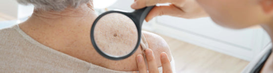 ¿Qué es y cómo prevenir el cáncer de la piel?