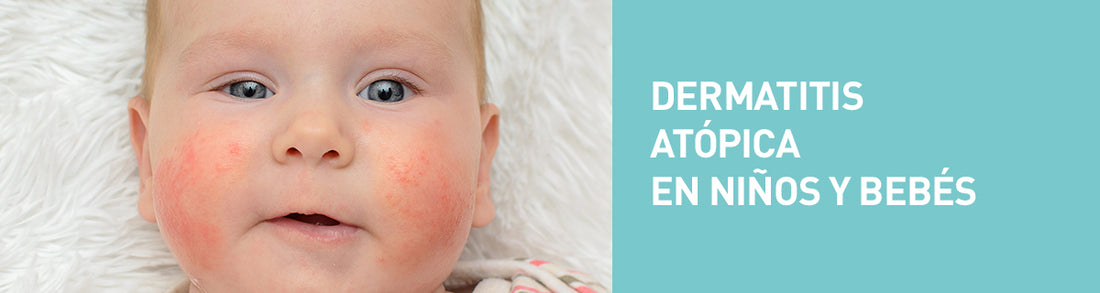 ¿Cómo prevenir la dermatitis atópica?